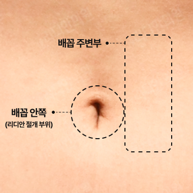 허벅지 지방흡입 - 리디안의원